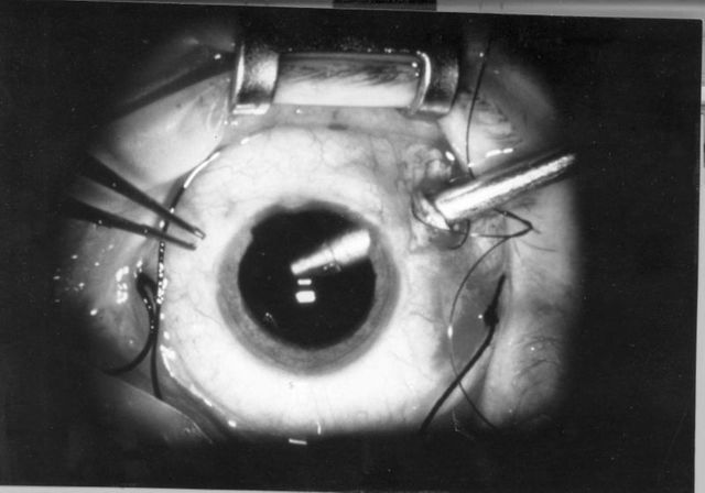 chirurgie oeil