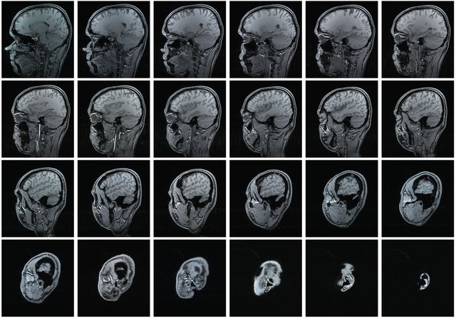 IRM cerveau