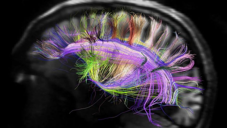 Le cerveau vu grâce à l'IRM de diffuson