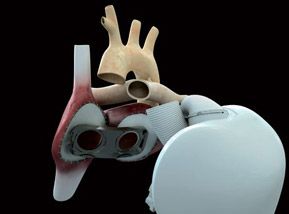 Coeur artificiel 289