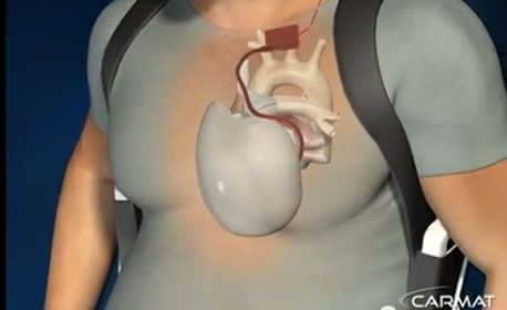 Le coeur artificel Carmat