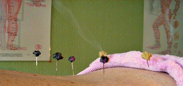 Acupuncture