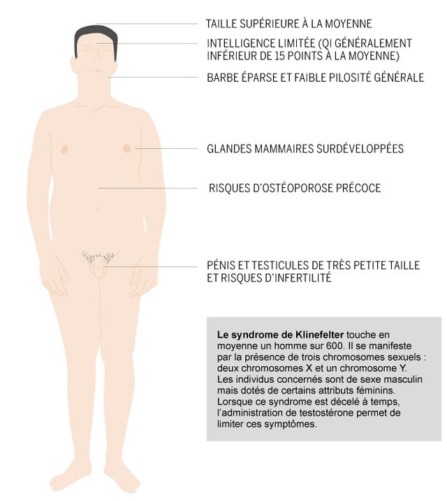 Le syndrome de Klinefelter
