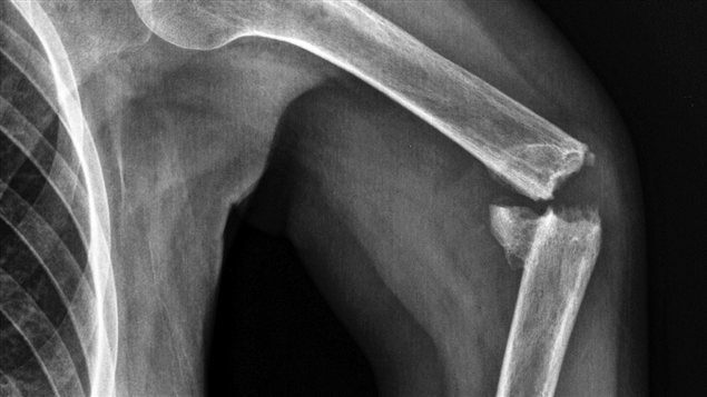 Fracture