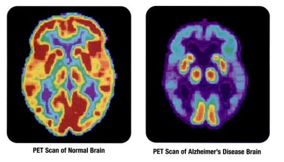 scanner cerveau normal/maladie d'Alzheimer