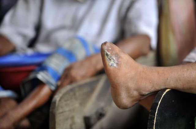 La lèpre, ici une léproserie au Bangladesh