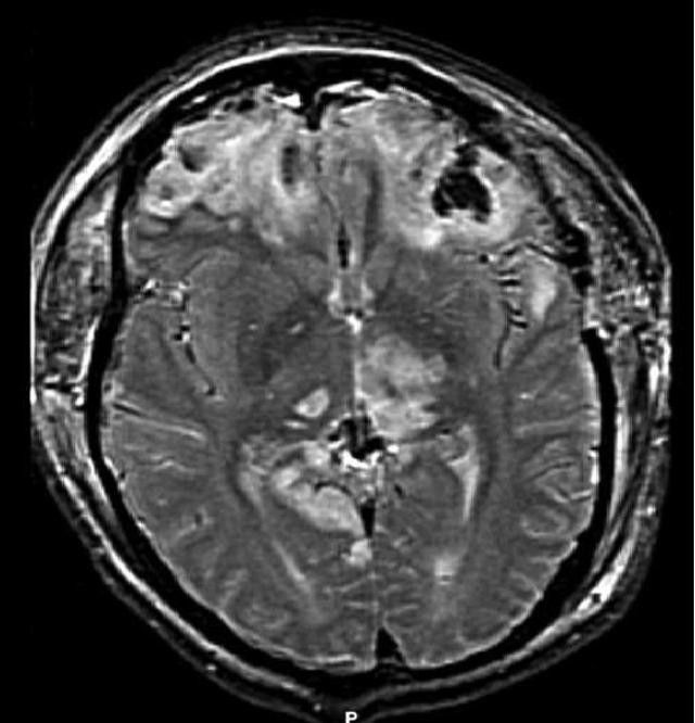 Brain_injury_with_herniation_MRI