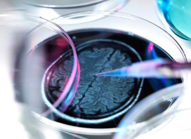 Recherches sur la maladie d'Alzheimer