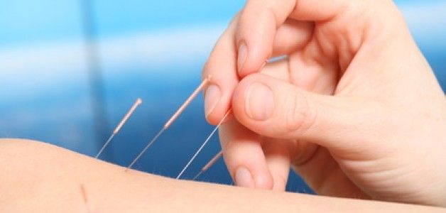 Acupuncture