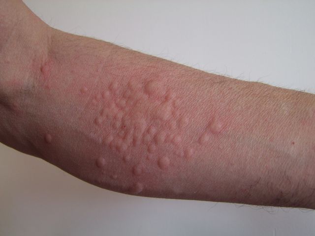 Réaction allergique