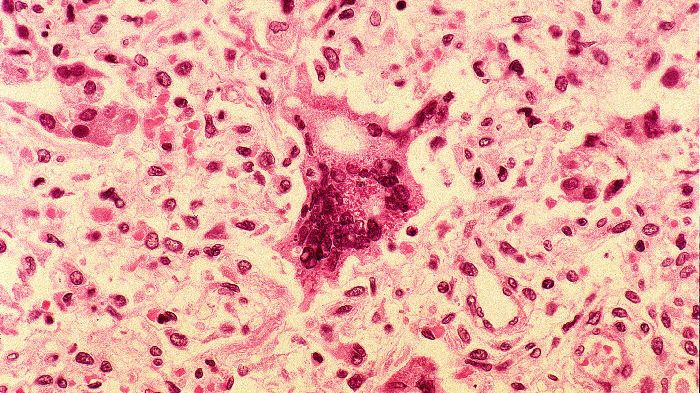 Cellule infectée par la rougeole