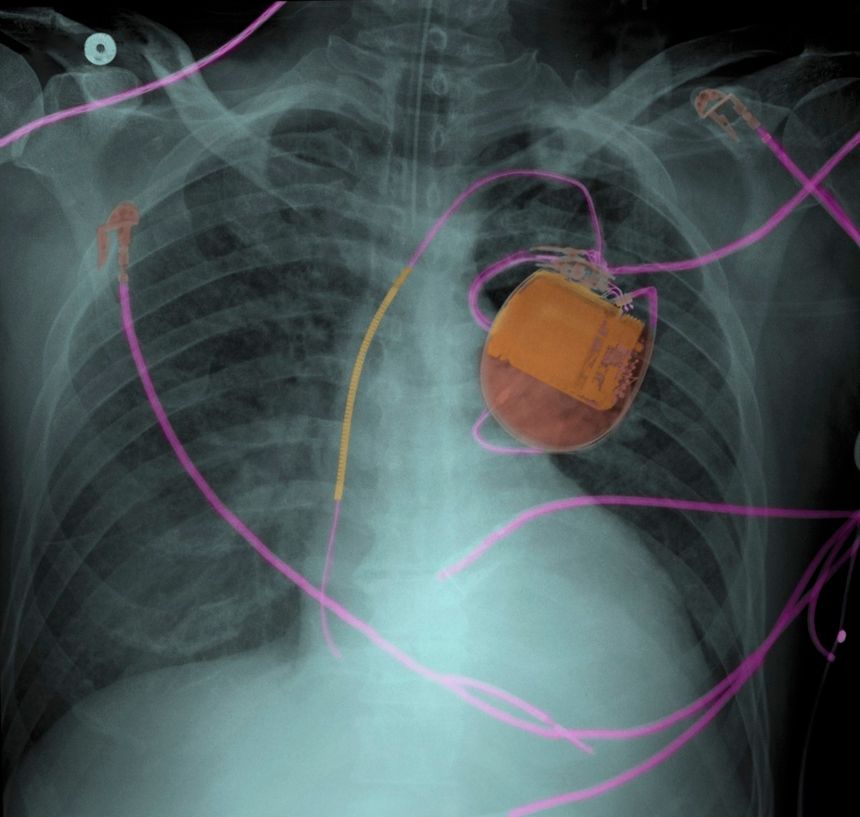 Radio d'une poitrine humaine avec un pacemaker