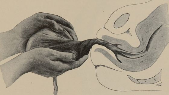 Manuel d'obstétrique pour sage-femme, 1910. - U.S. National Library of Medicine via Flickr