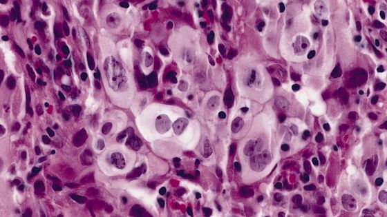 Le carcinome à grandes cellules - Creative Commons