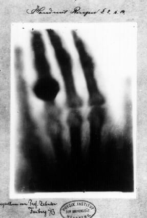 Le premier cliché anatomique radiographique par Wilhelm Röntgen.