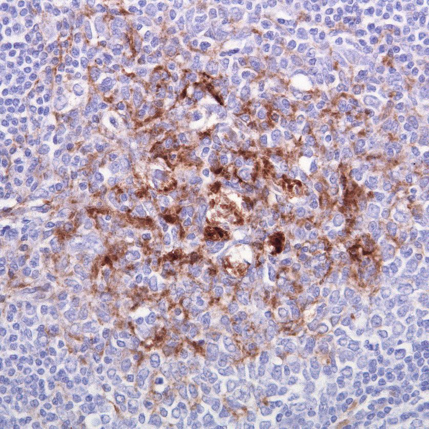 Accumulation d'un prion