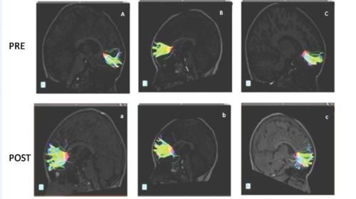 Suite à neuf mois d’enseignement musical, la neuroimagerie montre une croissance des fibres nerveuses et de nouvelles connections dans les régions associées au TSA et TDAH