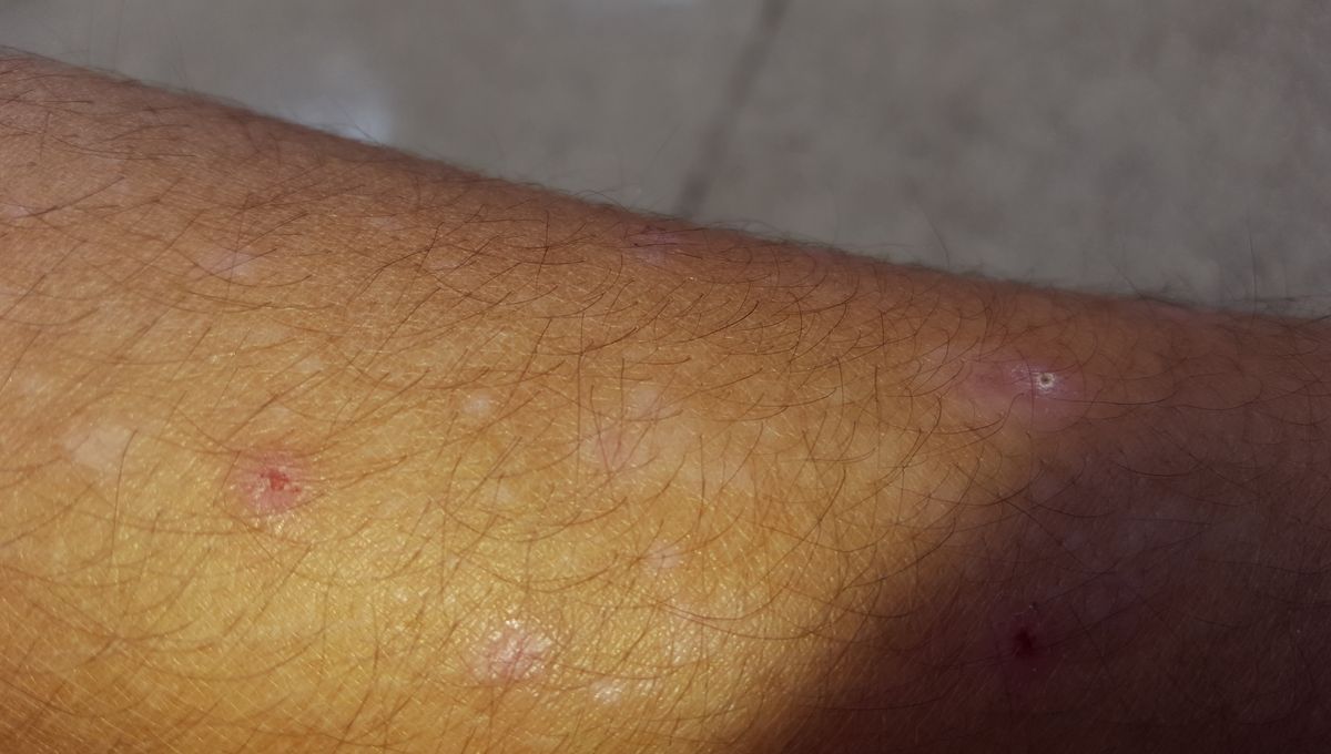 Les Punaises De Lit Donnent Des Cauchemars Et Des Boutons Aux Habitants Du Quartier Saint Vincent De Paul A Beziers