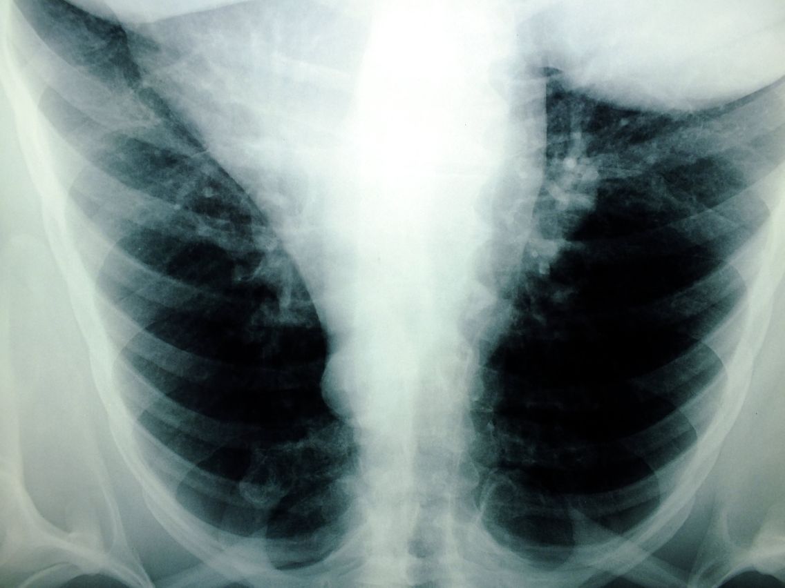 Le Cancer Du Poumon Pourrait Bientot Devenir Le Cancer Le Plus Mortel Chez Les Femmes Le Cancer Du Poumon Pourrait Bientot Devenir Le Cancer Le Plus Mortel Chez Les Femmes