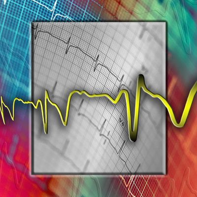 Electrocardiogramme