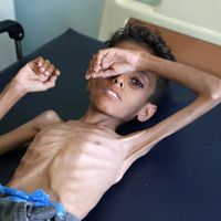 Un jeune garçon de 10 ans souffre de malnutrition, illustration de la crise humanitaire qui sévit au Yémen :