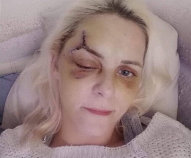 Vanessa blessée au flashball sur les Champs Elysées le 15 décembre 2018.