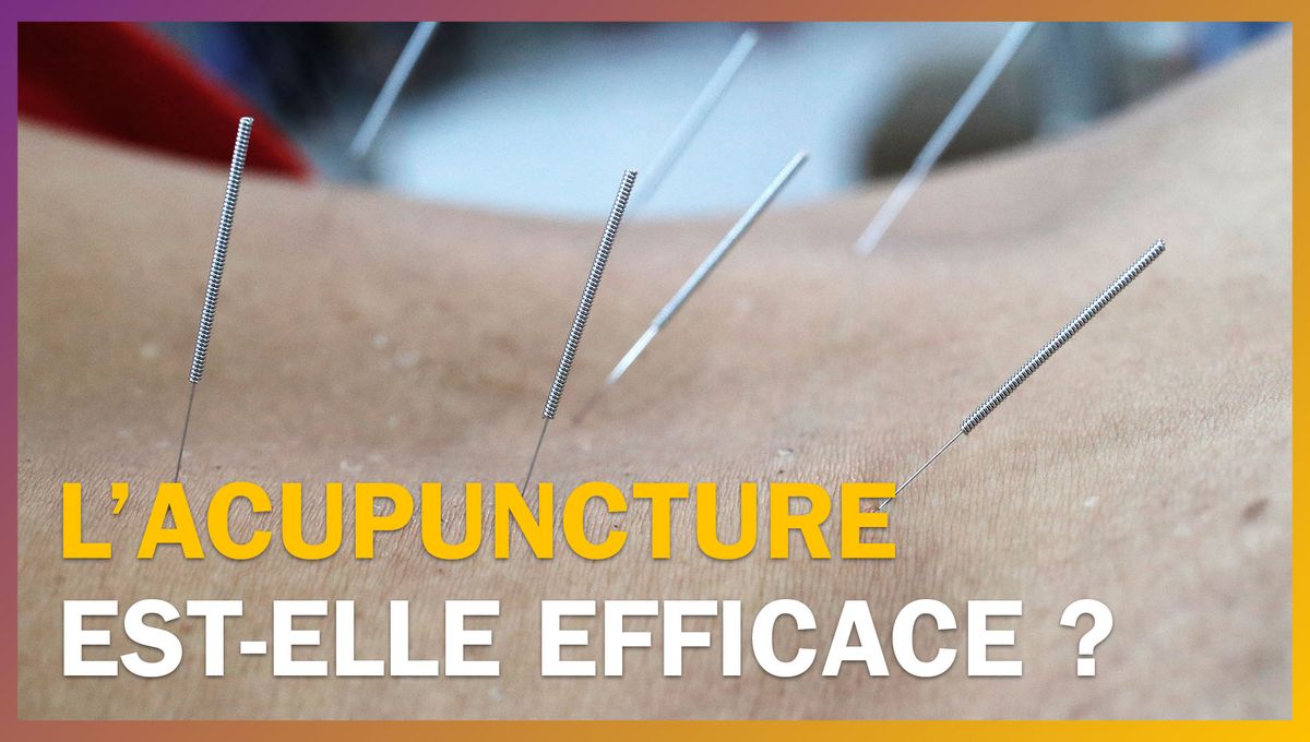 L’acupuncture est-elle efficace