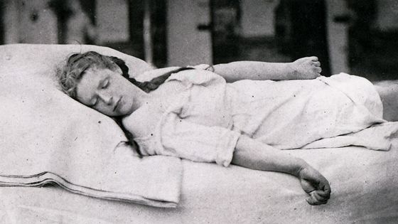 Désiré-Magloire Bourneville et Paul Regnard, iconographie photographique de la Salpêtrière, Paris, 1877-1880 : les médecins photographient les marqueurs supposés de l'hystérie, Charcot clamant que ce catalogue de symptômes est universel. ©Getty - Universal History Archive/Universal Images Group