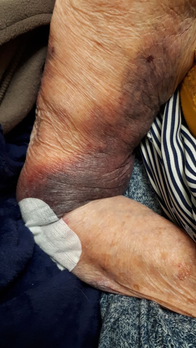 Lors d'une de ses visites, Christine a découvert un hématome sur la bras de sa mère, Huguette.