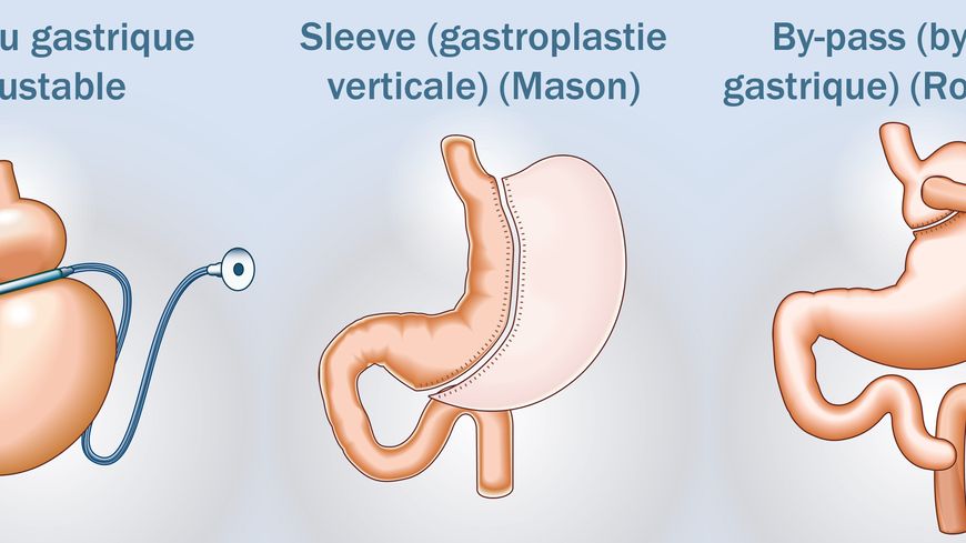 Schéma de trois opérations possibles sur l’estomac pour réduire la quantité d’aliments ingérés