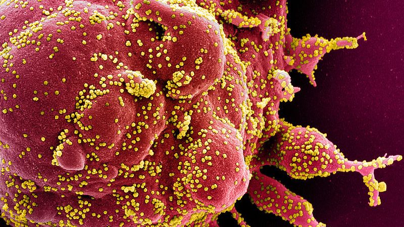 Cellule humaine sévèrement infectée par le SARS-CoV-2 (en jaune). 29 avril 2020.
