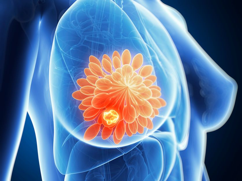 La Decouverte Du Kit De Survie Des Cancers Du Sein Les Plus Mortels
