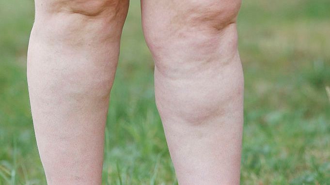 Comment se debarrasser de la retention d'eau dans le corps ?