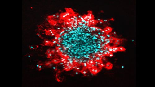 La découverte d’un mécanisme cellulaire responsable de l’aggravation des cancers du sein