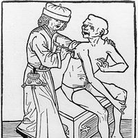 Hans Folz : Un médecin incisant un bubon de la peste, gravure sur bois, 1482