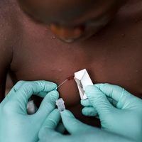 Quand la complosphère s'empare de la variole du singe. Ici malade au Congo