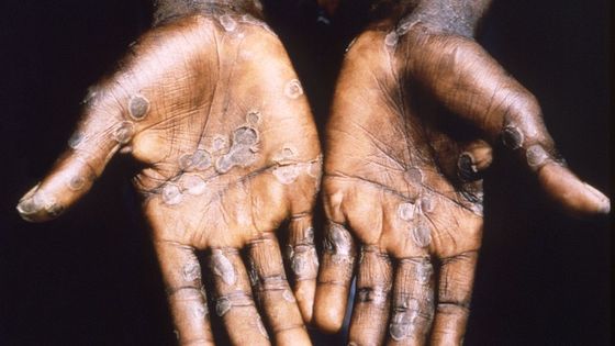 Le virus circule fréquemment en Afrique, mais la centaine de cas récemment répertoriés dans 11 pays interroge. ©Getty - Smith Collection/Gado