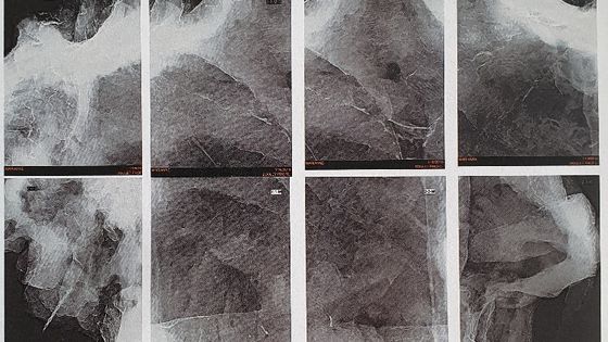 Radiographie du buste de la Marianne noire, par le Dr. Louis-Marie Desmaizières, au Centre Hospitalier Vétérinaire Equin à Grenade - Musée départemental de la Résistance et de la Déportation de Toulouse